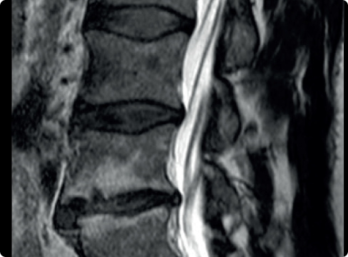 MRI LS oblasť