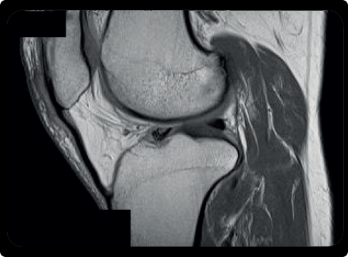 MRI ľavého kolena